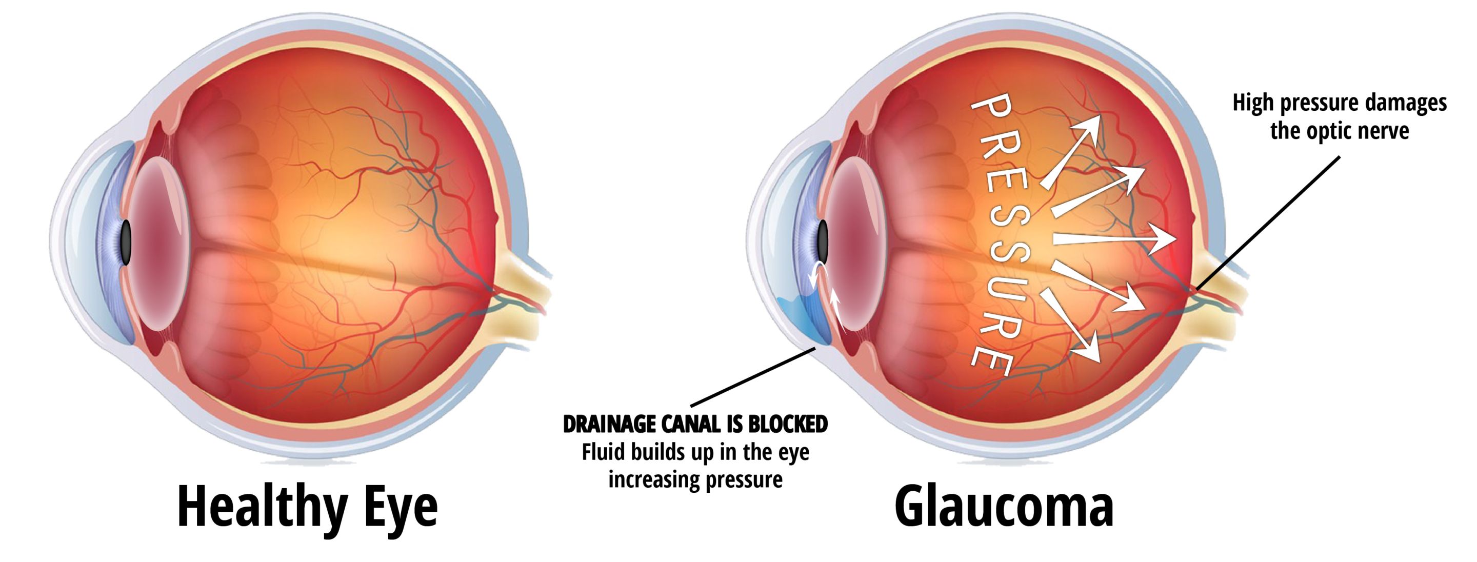 Healthy Eye Vs An Eye With Glaucoma